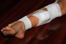 splint 