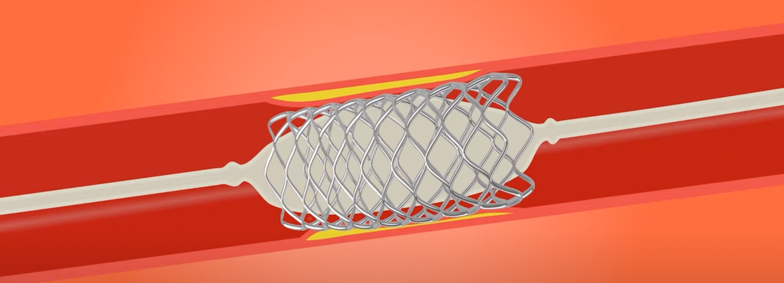 angioplasty with balloon and stent