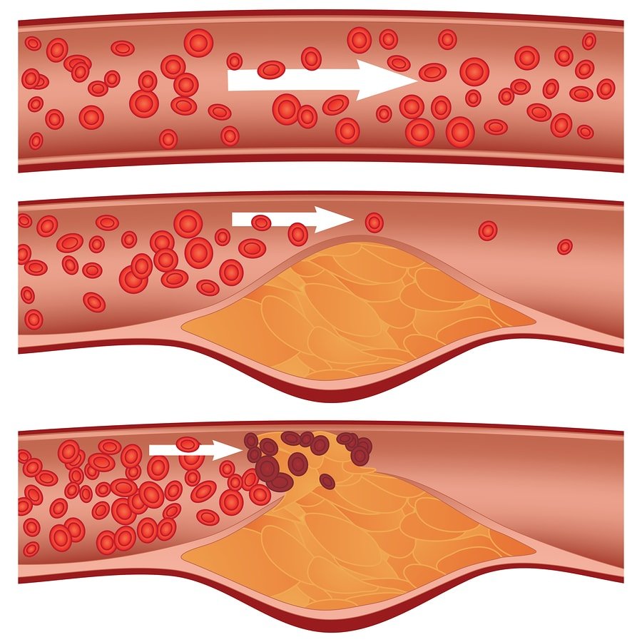 bigstock-Cholesterol