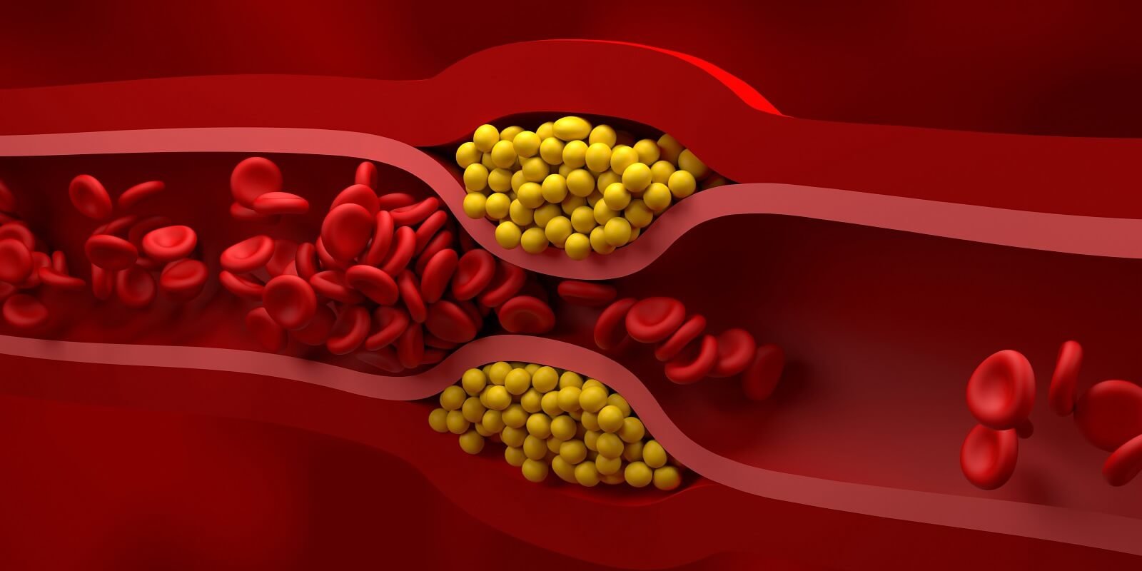 blocked-vessel-in-high-level-of-LDL-bad-cholesterol-lipoprotein