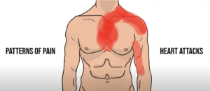 chest pain type with left hand paralysis