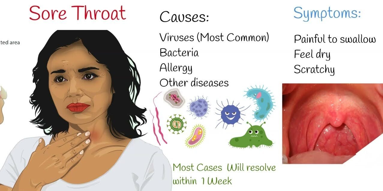 Symptoms Of Bacterial Sore Throat