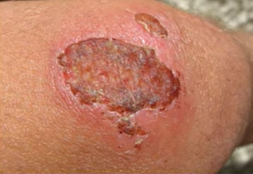 FIRST AID in ABRASION