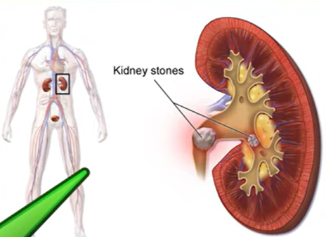 Preventing Kidney Stones