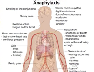 anaphylaxis.