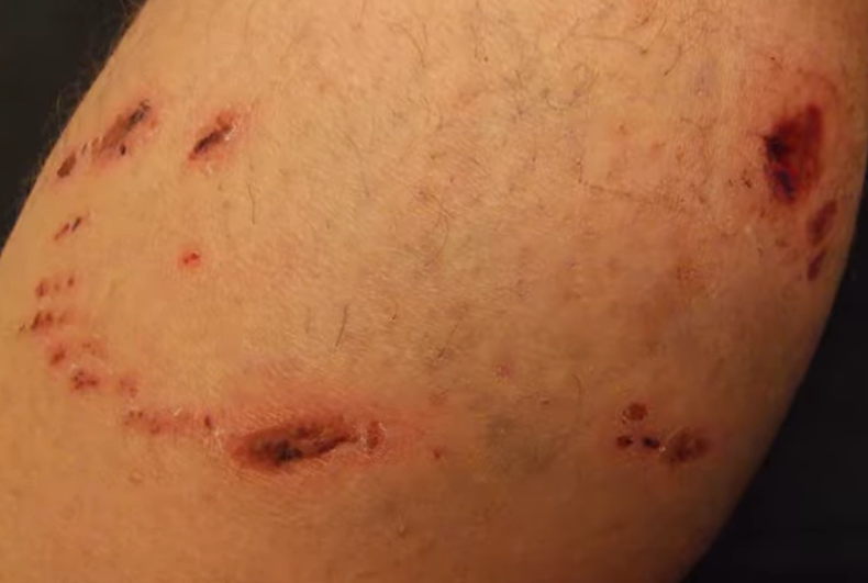 animal bites or scratches.