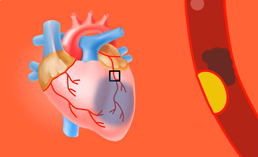 blood vessels and this is why heart attack