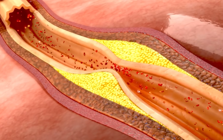 (coronary arteries)