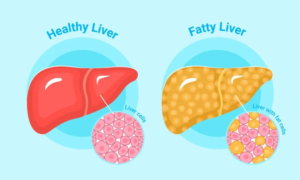 fatty liver