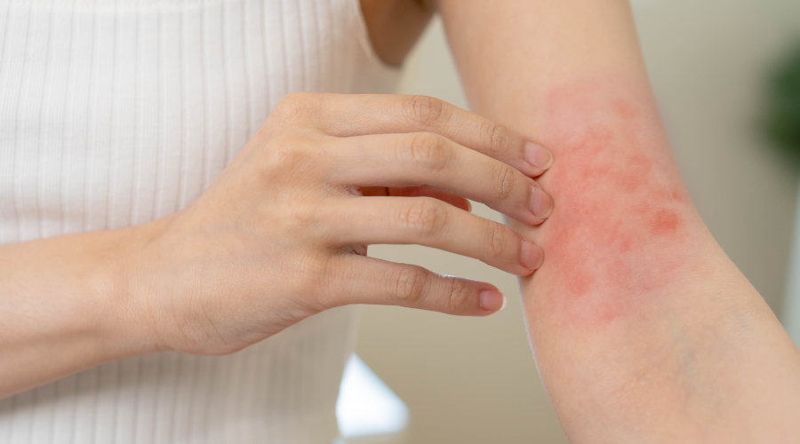 rashes