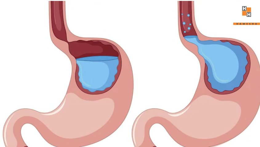 stomach starts going back into your food pipe.