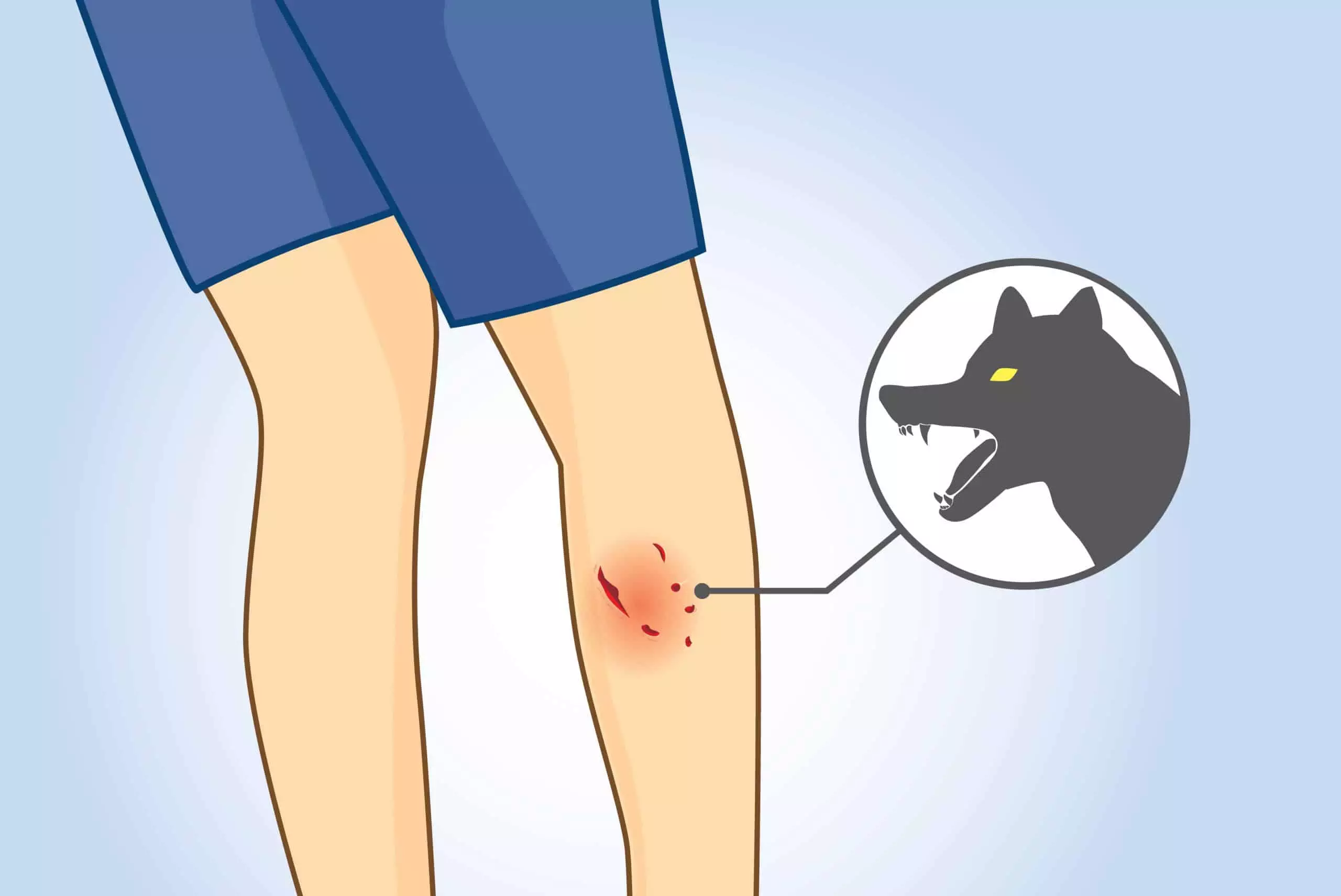 dog bite first aid