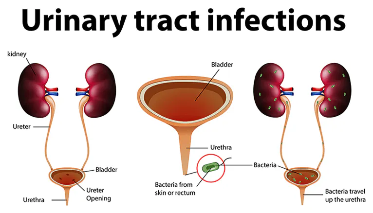 URINARY TRACT IMFECTION