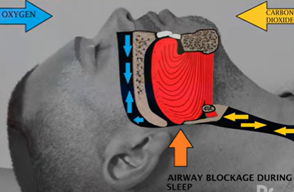 Snore